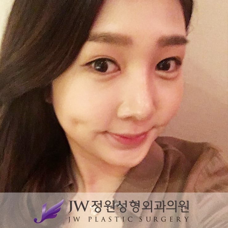 날렵하고 부드러운 이미지로! JW정원성형외과 매부리코성형 관련 이미지 6