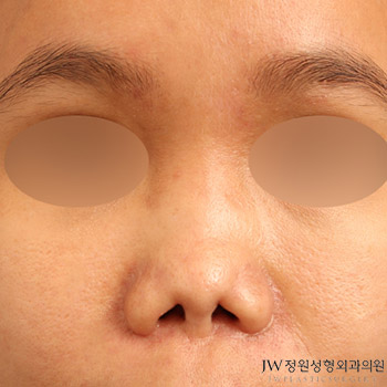 Collapsed Nose Revision Surgery, Safe Without Rejection Using Autologous Rib Cartilage! image 1