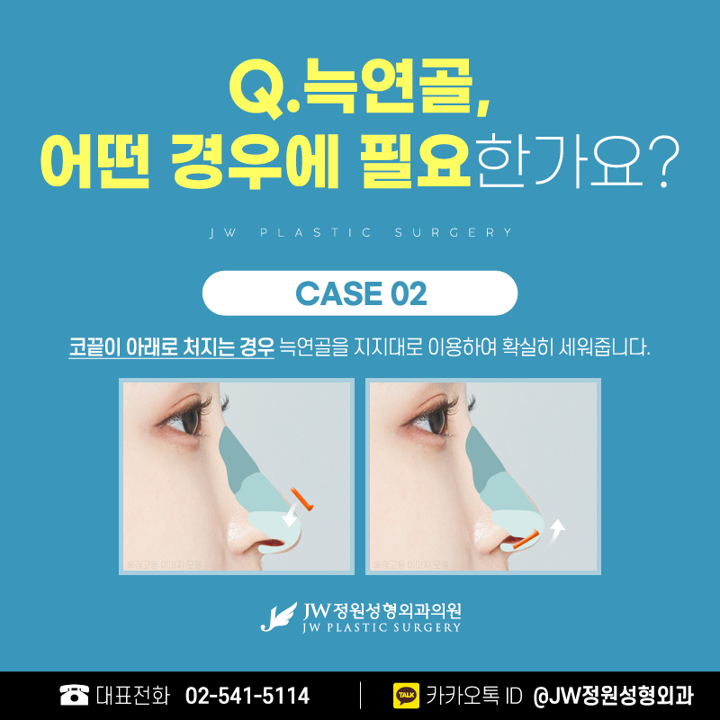늑연골코재수술 더 이상의 실패 없이 섬세하고 견고하게! 【강남 JW정원성형외과】 관련 이미지 4