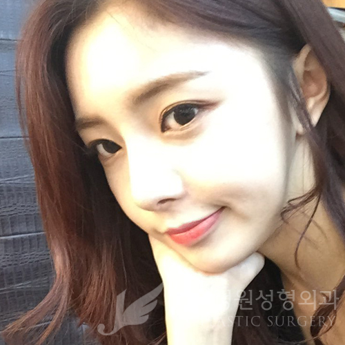 JW정원성형외과 코성형ː개방형 비개방형 수술방법이란? 관련 이미지 1