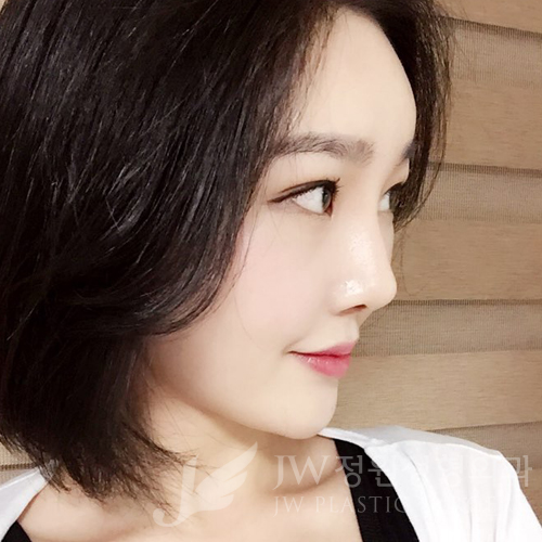 이마눈썹리프팅,눈매교정술,앞트임복원,코성형,지방이식 ⇒ JW정원성형외과에서! 관련 이미지 12