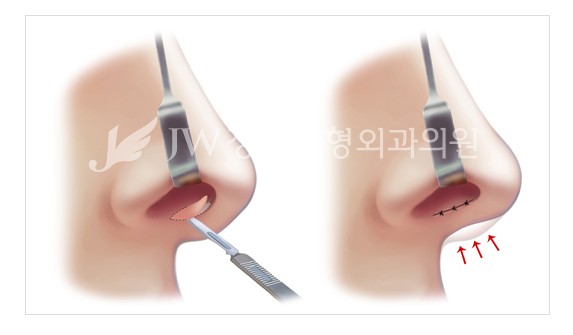 The Main Cause of a Long Nose in Aging! Making a Youthful Look with a Hooked Nose and Long Nose Surgery image 8