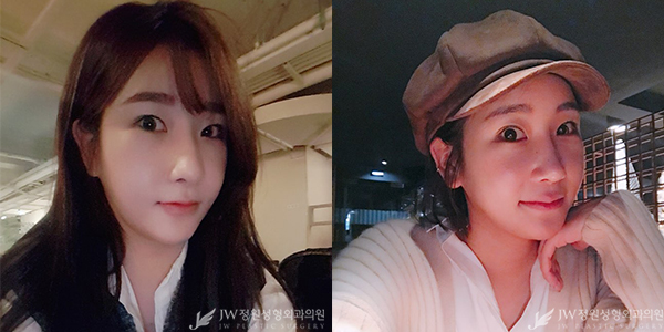 JW정원성형외과 눈+코성형으로 단아한 이미지 완성♡ 관련 이미지 4