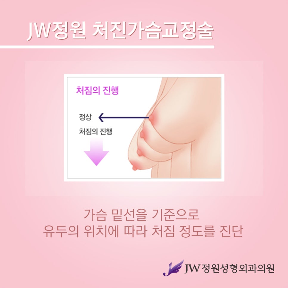 [JW정원성형외과] 처진가슴교정으로 자신감 회복! 관련 이미지 3