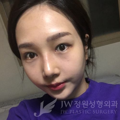 JW정원성형외과에서 매몰쌍꺼풀,앞트임,듀얼트임,코성형,넥리프팅으로 여신효과♡ 관련 이미지 11