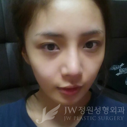 코재수술도 역시 JW정원성형외과 서만군원장 :] 관련 이미지 2