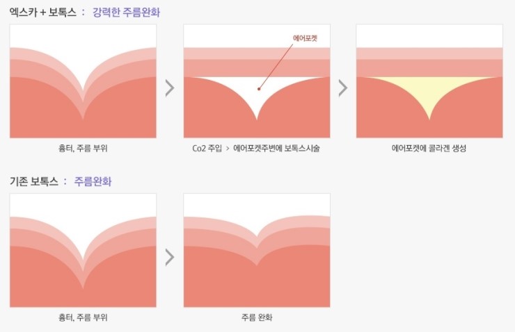 흉터? 주름? JW정원성형외과 엑스카로 말끔하게! 관련 이미지 4