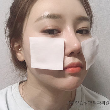 밋밋한 콧대, 3D 보형물로 원하는 만큼 높일 수 있다고? JW정원 3D보형물 코성형으로 알아봐요 관련 이미지 1