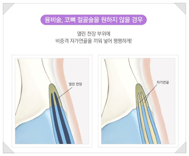 Creating a Soft Line with Hump Nose Correction for a Prominent Bridge and Drooping Tip image 6
