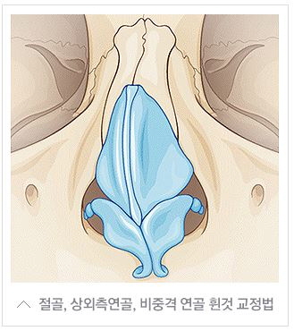 휜코교정 근본적인 미용/기능 개선(코막힘, 비염, 두통 등) 관련 이미지 6