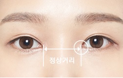 답답한 눈매를 시원하고 자연스럽게! JW정원 앞트임 성형 관련 이미지 5