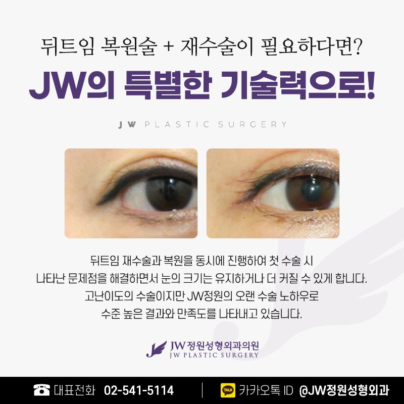 뒤트임재수술 다시 붙을 걱정 없이 【강남 JW정원성형외과】 관련 이미지 3