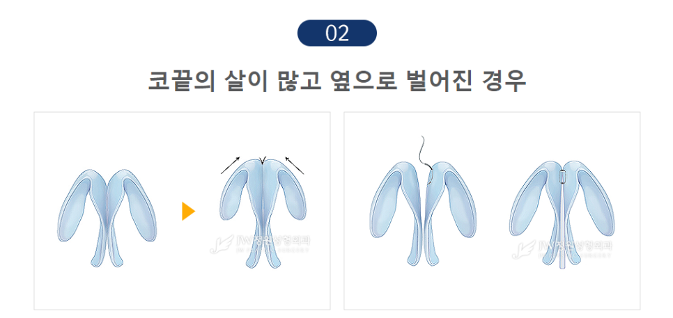 촌스러움 노노! 세련된 라인, JW정원성형외과 콧볼축소 관련 이미지 7