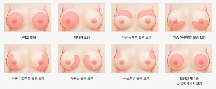 내 것으로 채우는 진짜 볼륨감! JW정원성형외과 줄기세포 가슴확대 관련 이미지 6