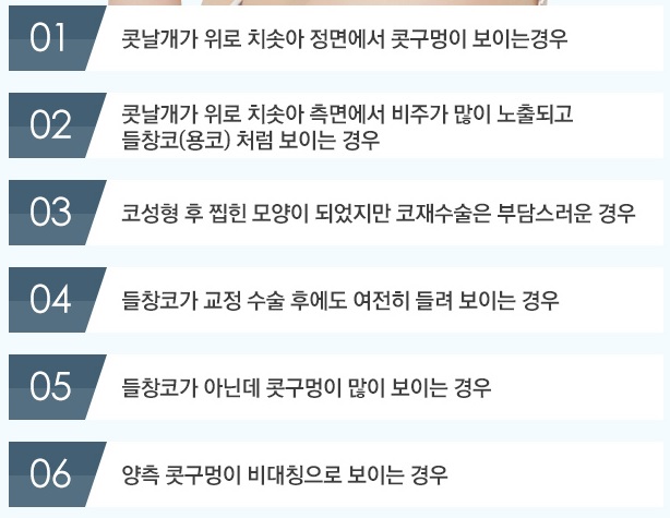 촌스러운 이미지에서 세련된 인상으로! JW정원성형외과 콧날개교정술 관련 이미지 3