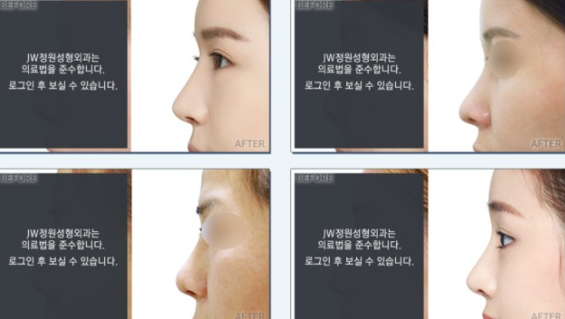 Nose Revision Surgery and Tip Plasty for a Soft, Flexible Pig Nose Look! image 5