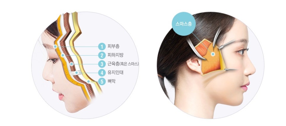 [JW정원 스마스리프팅] 꽃중년 미모의 완성, 스마스리프팅으로 관련 이미지 2
