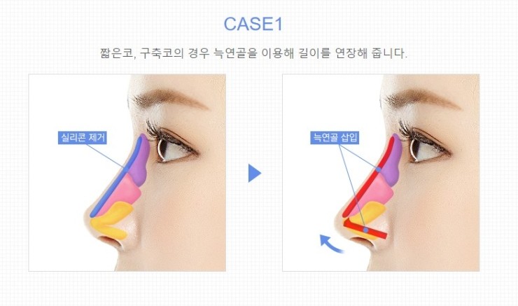 재수술 없는 JW정원성형외과 늑연골 코성형 관련 이미지 3