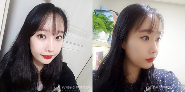 JW정원성형외과 자가지방이식으로 아름다움 완성♥ 관련 이미지 4