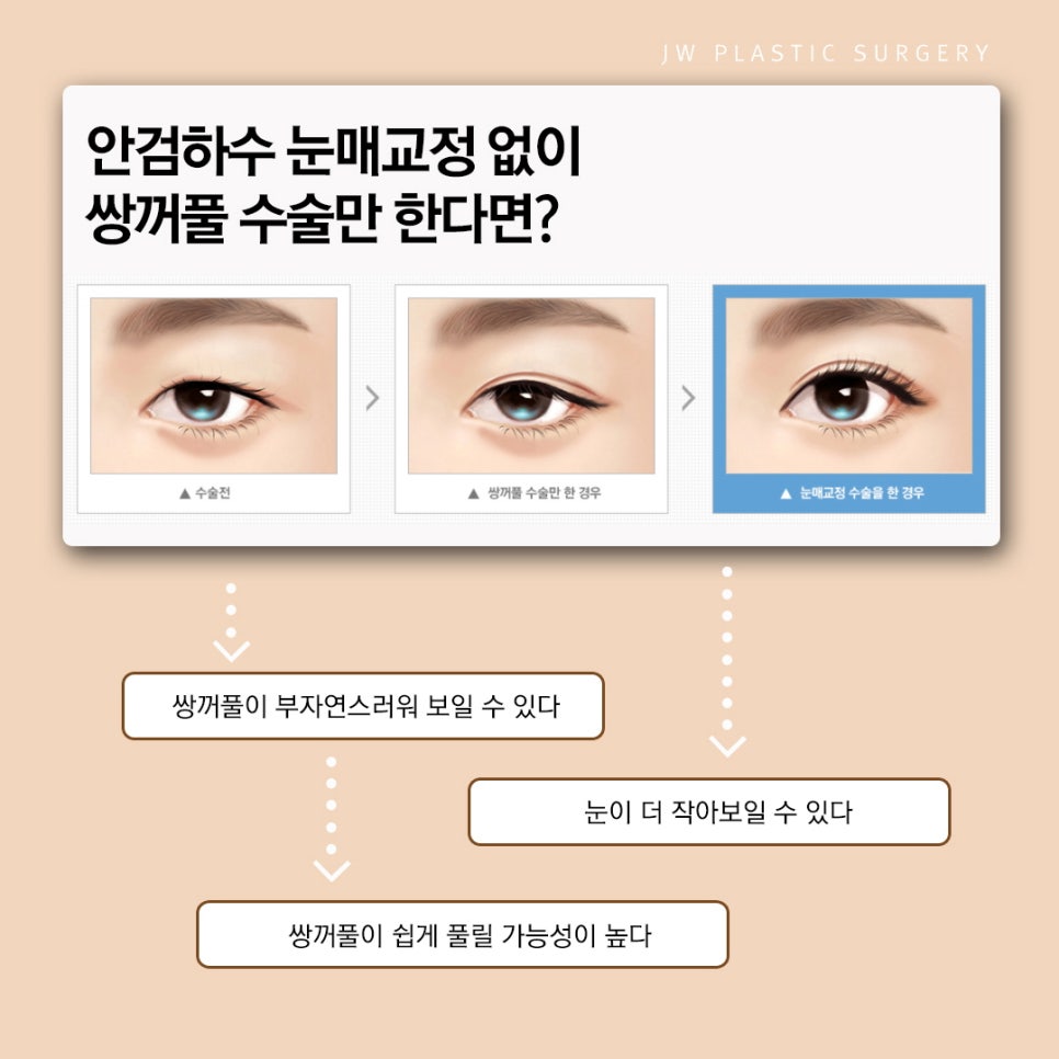 Not Just Simple Double Eyelid Surgery: Improve Eye-Opening Strength with Ptosis Correction image 2