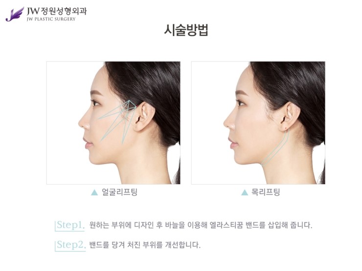 [JW정원성형외과] 더 탄력있고, 더 오래가는 엘라스티꿈 리프팅 관련 이미지 4