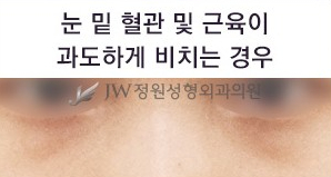 Best Place for Under-Eye Fat Repositioning, with a Surgical Method Suited to My Under-Eyes image 4