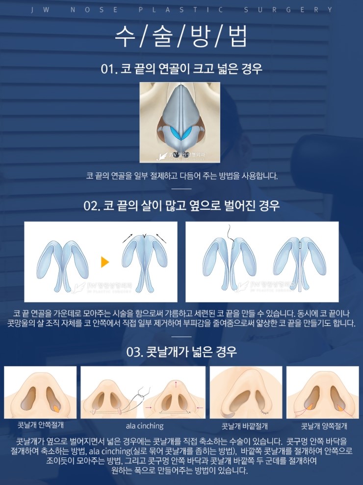 콧대와의 밸런스를 고려한 슬림한 코끝 JW정원성형외과 복코교정 관련 이미지 6