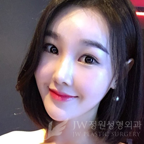 이마눈썹리프팅,눈매교정술,앞트임복원,코성형,지방이식 &rArr; JW정원성형외과에서! 관련 이미지 17