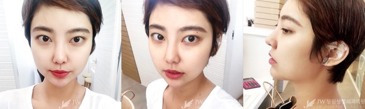 울퉁불퉁한 얼굴라인&rarr;JW정원지방이식으로 매끈하게! 관련 이미지 6