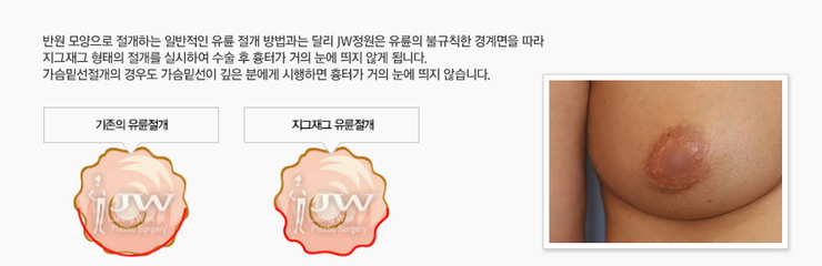 최소박리로 안전하게 황금비율의 가슴을 만드는 HD 내시경 가슴확대 관련 이미지 5