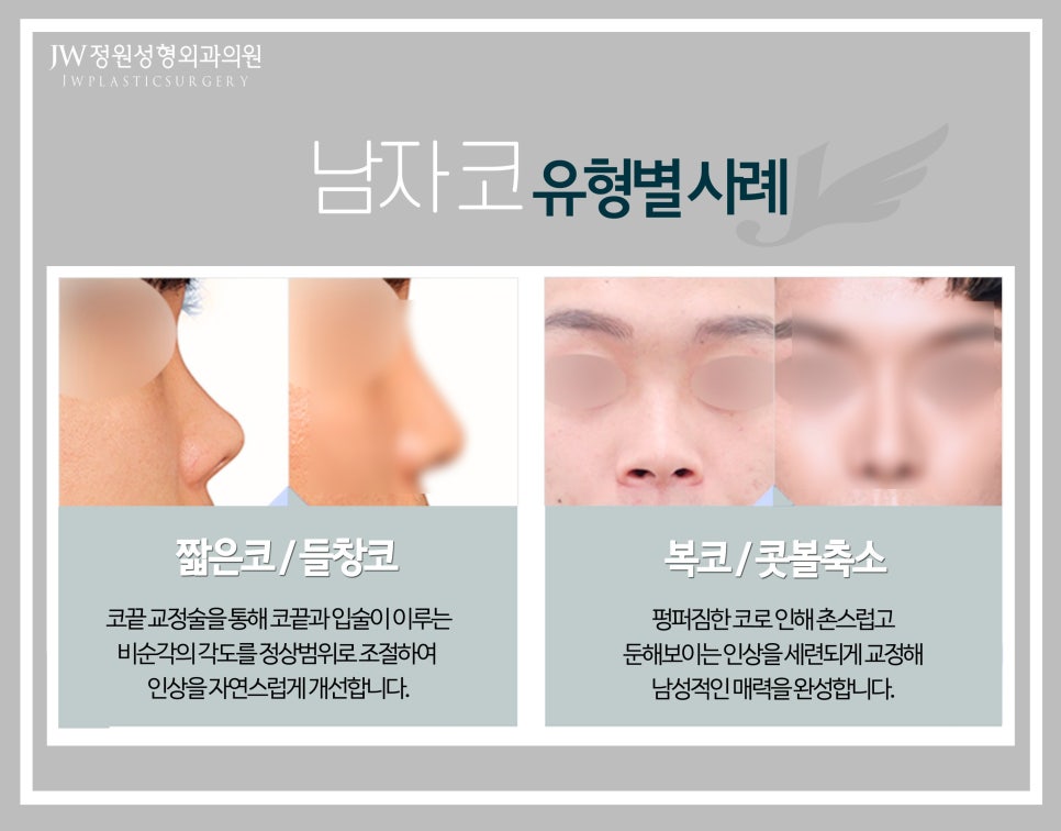 JW Male Rhinoplasty for a Refined Straight Line image 6