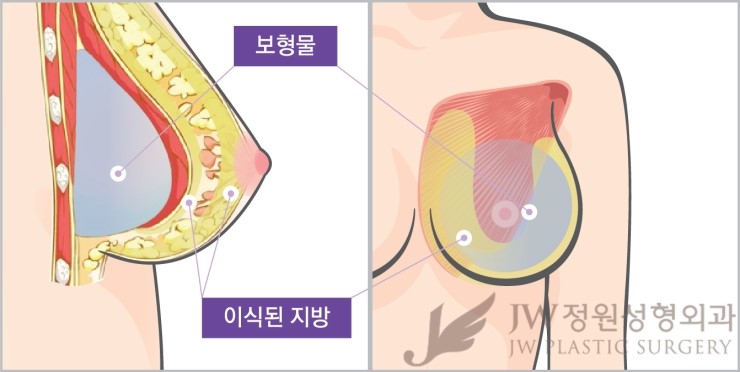 JW정원성형외과 가슴성형 √HD내시경 √하베스트젯2 √콤비네이션 가슴확대 관련 이미지 3