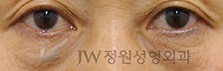 밝고 맑은 인상으로 변신, 눈밑지방재배치! JW정원성형외과에서~ 관련 이미지 4