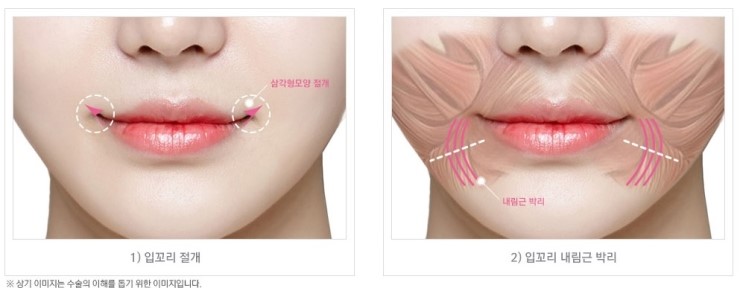 아름다운 미소의 완성! JW정원성형외과 입꼬리 성형 관련 이미지 3