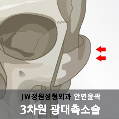 JW정원성형외과의 특별한 『3차원 광대축소술』 관련 이미지 7