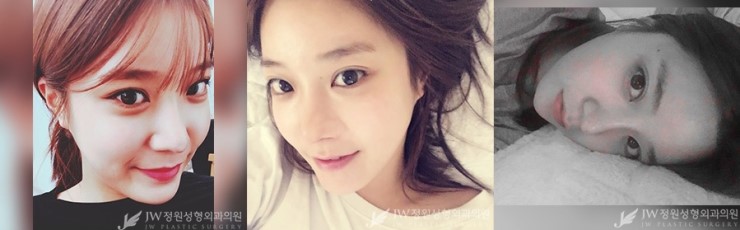 [JW정원성형외과] 안면윤곽 코성형 리얼 후기!!! 관련 이미지 5
