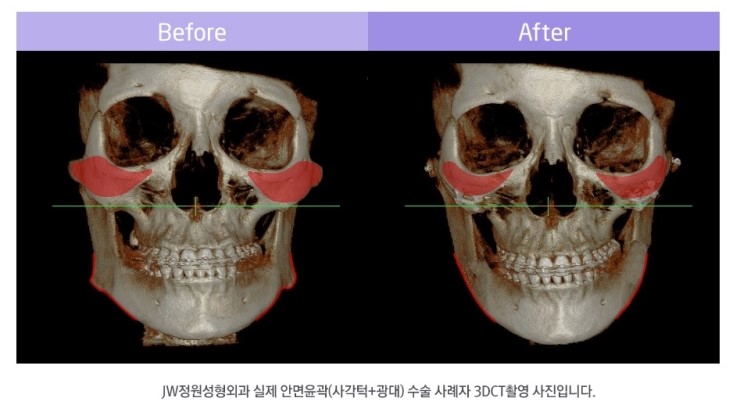 최소 절제로 만드는 아름다운 얼굴라인 JW정원성형외과 안면윤곽 관련 이미지 2