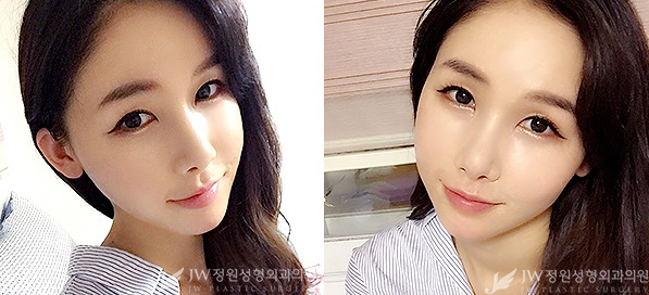 매끈한 콧날과 완벽브이라인 ▶ JW정원성형외과에서!!! 관련 이미지 2