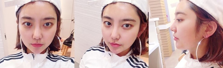 울퉁불퉁한 얼굴라인&rarr;JW정원지방이식으로 매끈하게! 관련 이미지 4