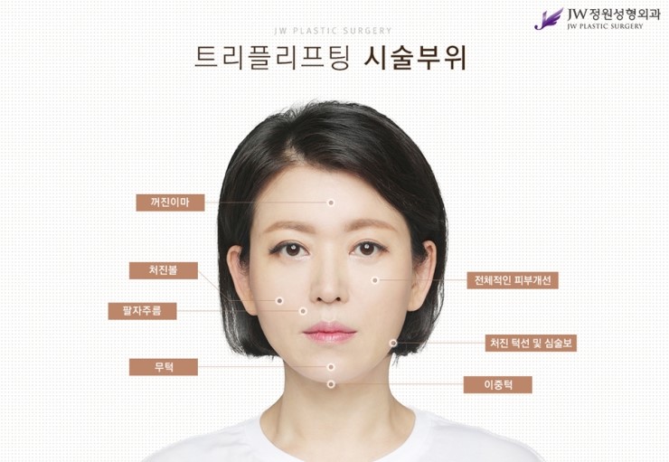 [JW정원성형외과] 리프팅성형비용 보다 리프팅효과가 확실한 트리플 리프팅으로 고민해결! 관련 이미지 7