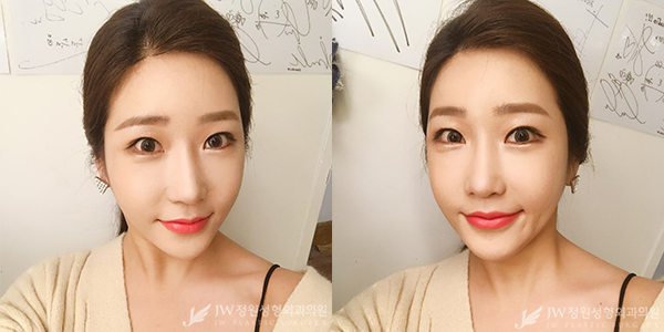 JW정원성형외과 눈+코성형으로 단아한 이미지 완성♡ 관련 이미지 5