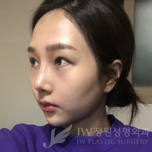 JW정원성형외과에서 매몰쌍꺼풀,앞트임,듀얼트임,코성형,넥리프팅으로 여신효과♡ 관련 이미지 12