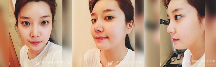 [JW정원성형외과] 안면윤곽 코성형 리얼 후기!!! 관련 이미지 4