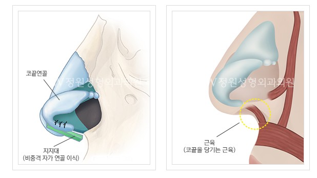 Hump Nose Diagnosis, for a More Natural Appearance image 6