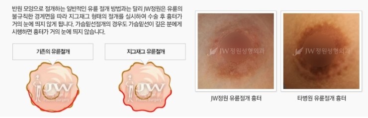 보형물+지방이식 장점만을 담은 JW정원성형외과 콤비네이션 가슴확대 관련 이미지 7