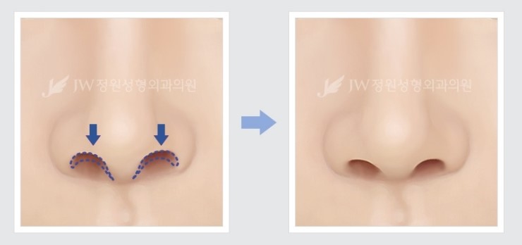 [JW정원성형외과] 코성형, 어려울수록 자신 있습니다! 관련 이미지 11
