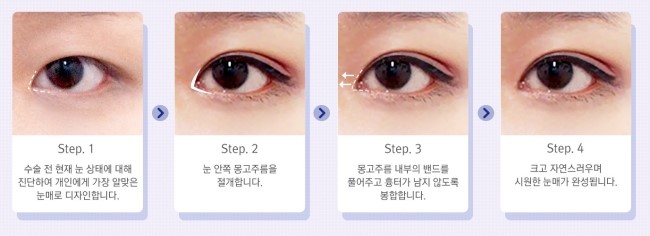 답답한 눈매를 시원하고 자연스럽게! JW정원 앞트임 성형 관련 이미지 3