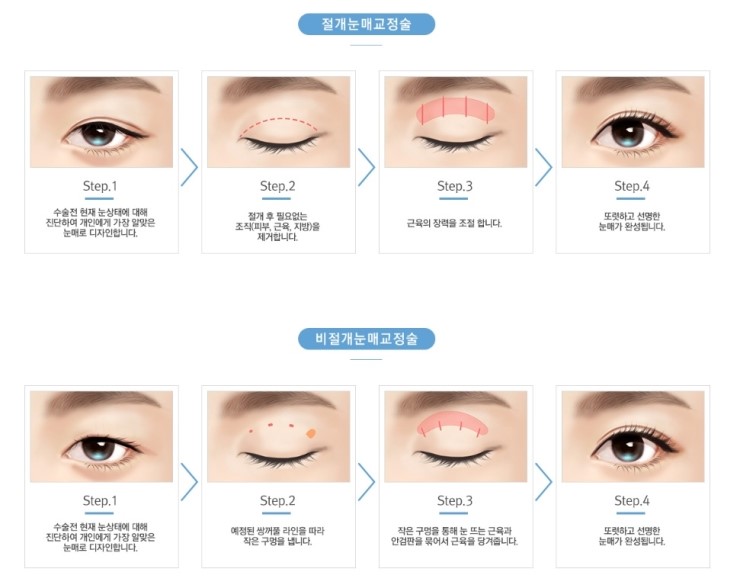 졸려 보이는 눈, 답답한 눈매 JW정원성형외과 눈매교정술로! 관련 이미지 2