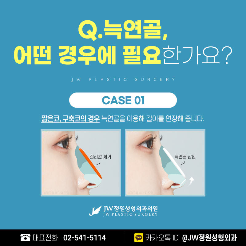 늑연골코재수술 더 이상의 실패 없이 섬세하고 견고하게! 【강남 JW정원성형외과】 관련 이미지 3