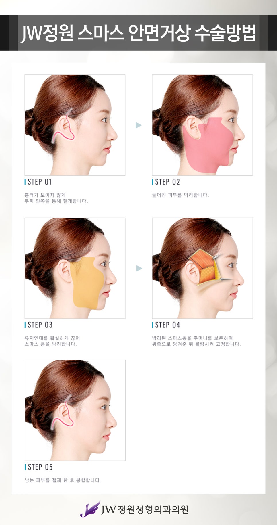 Wrinkle Improvement in Your 40s to 60s: SMAS Facelift Lifting image 3